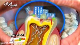 عوامل موثر بر پوسیدگی دندان