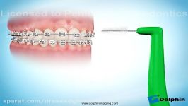 نحوه استفاده مسواک بین دندانی