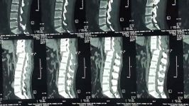 درمان ضایعه نخاعی طب سوزنی آقای پور جعفری