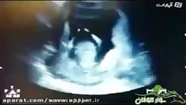 دست زدن عجیب نوزاد داخل شکم رَحِم مادرش