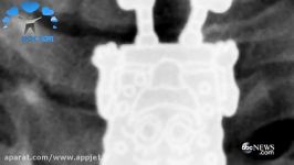 عجیب اما واقعی باب اسفنجی در عکس رادیولوژی یک کودک