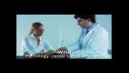 carpal tunnel syndrome