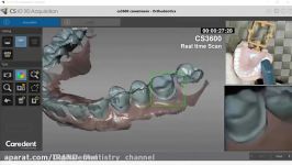 intra oral scanner cs3600 scan procedure