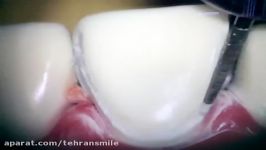نمونه تراش لامینیت دندان