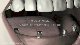 Mini Dental ImplantsMDL