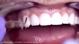 چرا نگران سفیدشدن دندان ها هستید؟ این تکنولوژی روببینید
