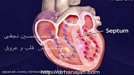 بیماری هیپرتروفیک کاردیومیوپاتی انسدادی