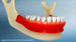 کشیدن دندان عقل برای نظم دندان ها ارتودنسی