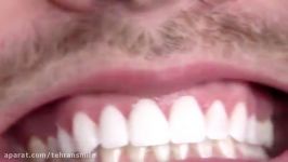لامینیت دندان بدون تراش