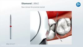 Preparation rules for ceramic inlays and partial crowns