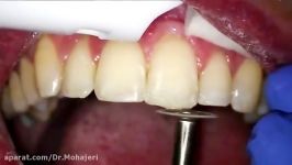 How to Repair Chipped or Broken Tooth