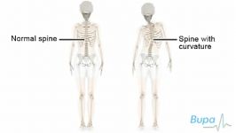 How idiopathic scoliosis occurs