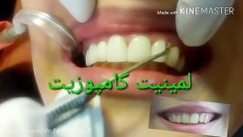 درمان کامپوزیت زیبایی دندانهای قدامی دکتر فربد دستنبو