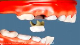 عدم حفظ فضای دندانهای دائمی پس کشیدن دندانهای شیری