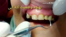 افزایش طول تاج دندانها درمانهای زیبایی لثه