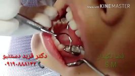 اهمیت فضانگهدار در دندانپزشکی اطفال دکتر فربد دستنبو