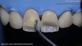 ترمیم مستقیم دندانهای قدامی