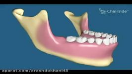 جراحی دندان عقل نهفته