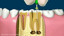 ویدیو عصب کشی روکش دندان