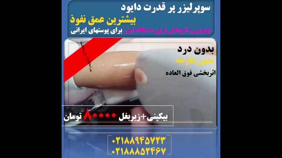 از بین بردن موهای زائد دستگاه لیزر دایود 2