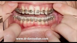 قبل بعد ارتودنسی بدون کشیدن دندان  دکتر داوودیان