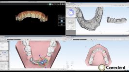 CS CAD Ortho Carestream CS3500 Intraoral scanner