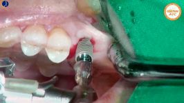 Flapless Surgery Osstem Implant System