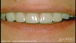 باندینگ دندانها کامپوزیت زیبایی  دندانپزشک فرمانیه