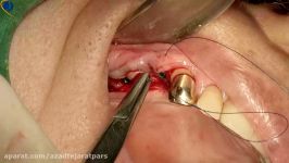 Advance Sinus Lift Surgery