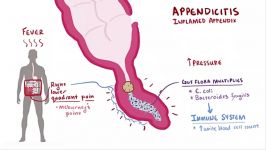 Appendicitis  signs symptoms