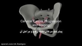 پیشرفت سرطان دهانه رحم مراحل آن