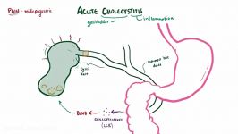 Acute cholecystitis  pathophysiology symptoms