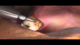 روش خارج کردن آبسه دندانی