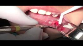 آبسه دندانی