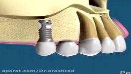 اتصال دندان به ایمپلنت بریج کردن دندان به ایمپلنت