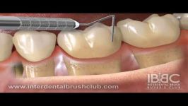 اهمیت استفاده مسواک های بین دندانی پس جراحی پریو