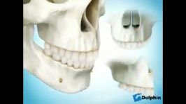 جراحی ارتومانتیگل برای اصلاح لبخند لثه ای
