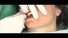 آزمایش غربالگری سرطان دهان