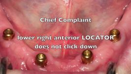 Locator Dental Implant Attachments