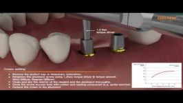 ETIII fixture with Transfer Abutment Surgical Prothesis