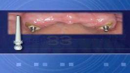 راین 83Root Retained Overdentures