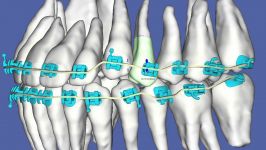 Straight Talk on Orthodontics