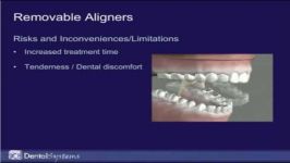 Removable Aligners