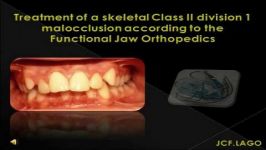 درمان اسکلتی کلاس 2 گروه 1 مال اکلوژن