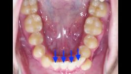 ارتودنسی بدون کشیدن دندان  کلینیک سیمادنت