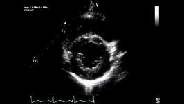 اکوکاردیوگرافی دوبعدی بلادرنگ یک قلب نرمال ب  Real time two dimensional echocardiography b