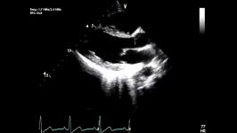 اکوکاردیوگرافی دوبعدی بلادرنگ یک قلب نرمال الف  Real time two dimensional echocardiography a