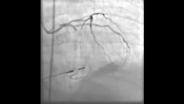 آنژیوگرافی عروق کرونر  Coronary Angiography