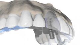 ایمپلنت دندان قدامی بالا پیوند استخوان