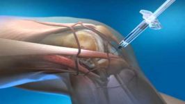 چگونه درمان پزشکی زانو درد تزریق داور به زانو
